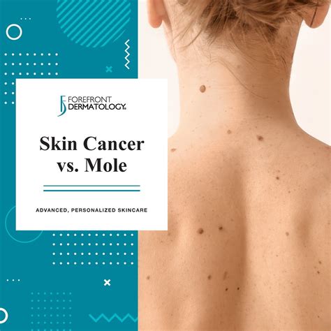 skin cancer vs normal mole